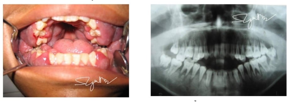 Đột ngột sưng lợi, vào viện phát hiện u máu ác tính